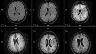 En esta imagen se muestra el devastador efecto que el consumo de la cocaína tiene sobre el cerebro
